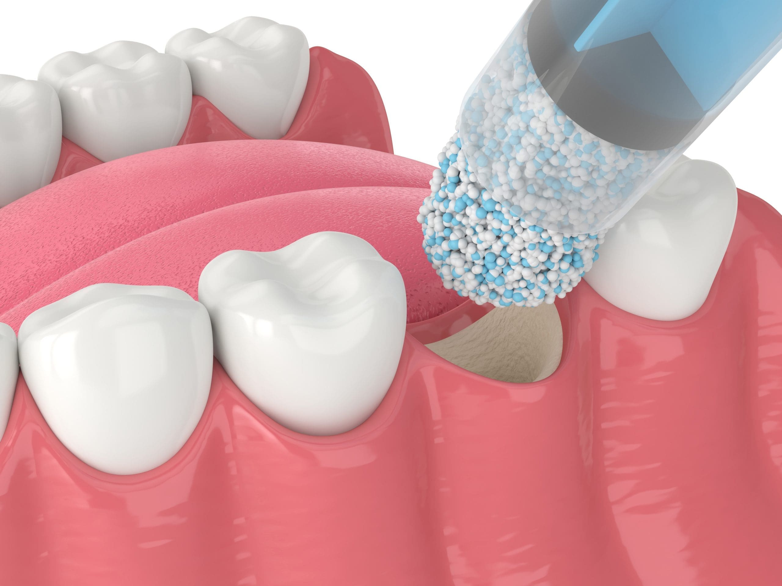 Bone Grafting | Norwood Dental Cosmetics