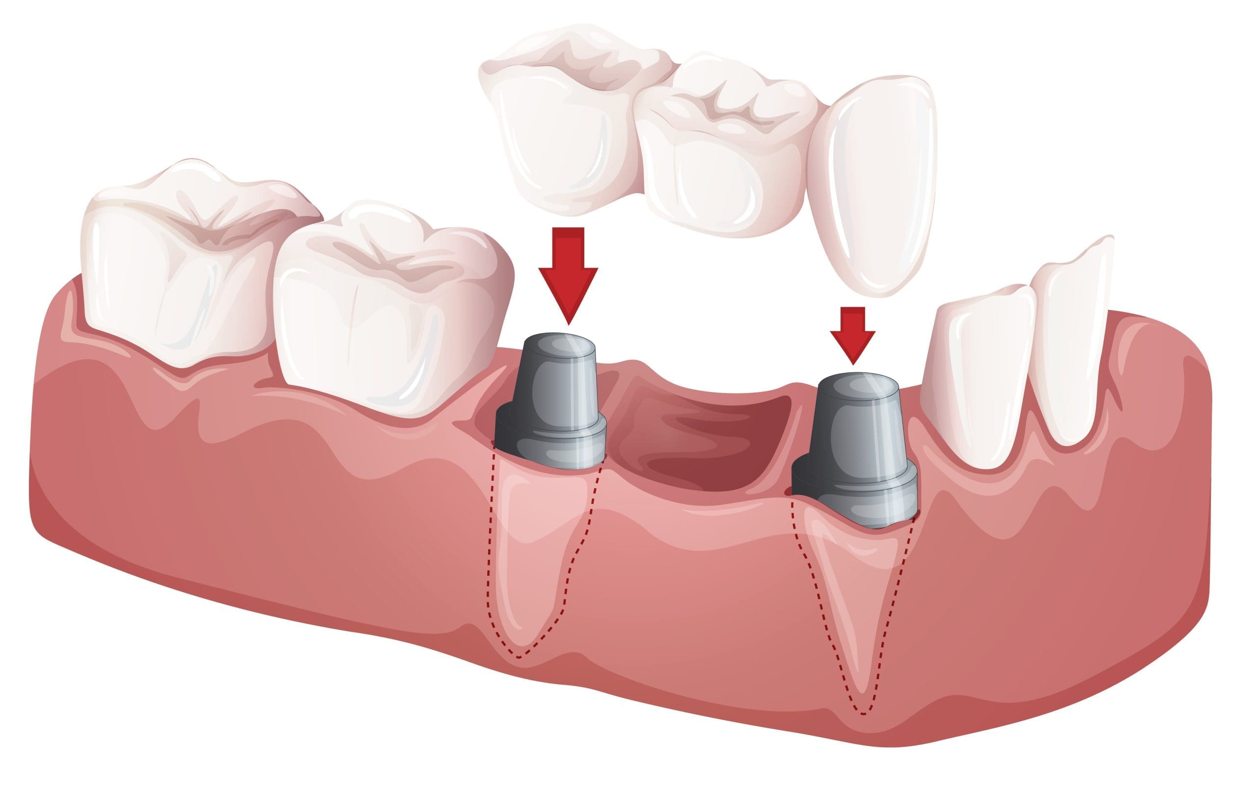 Norwood Dental Bridges Norwood Dental Cosmetics