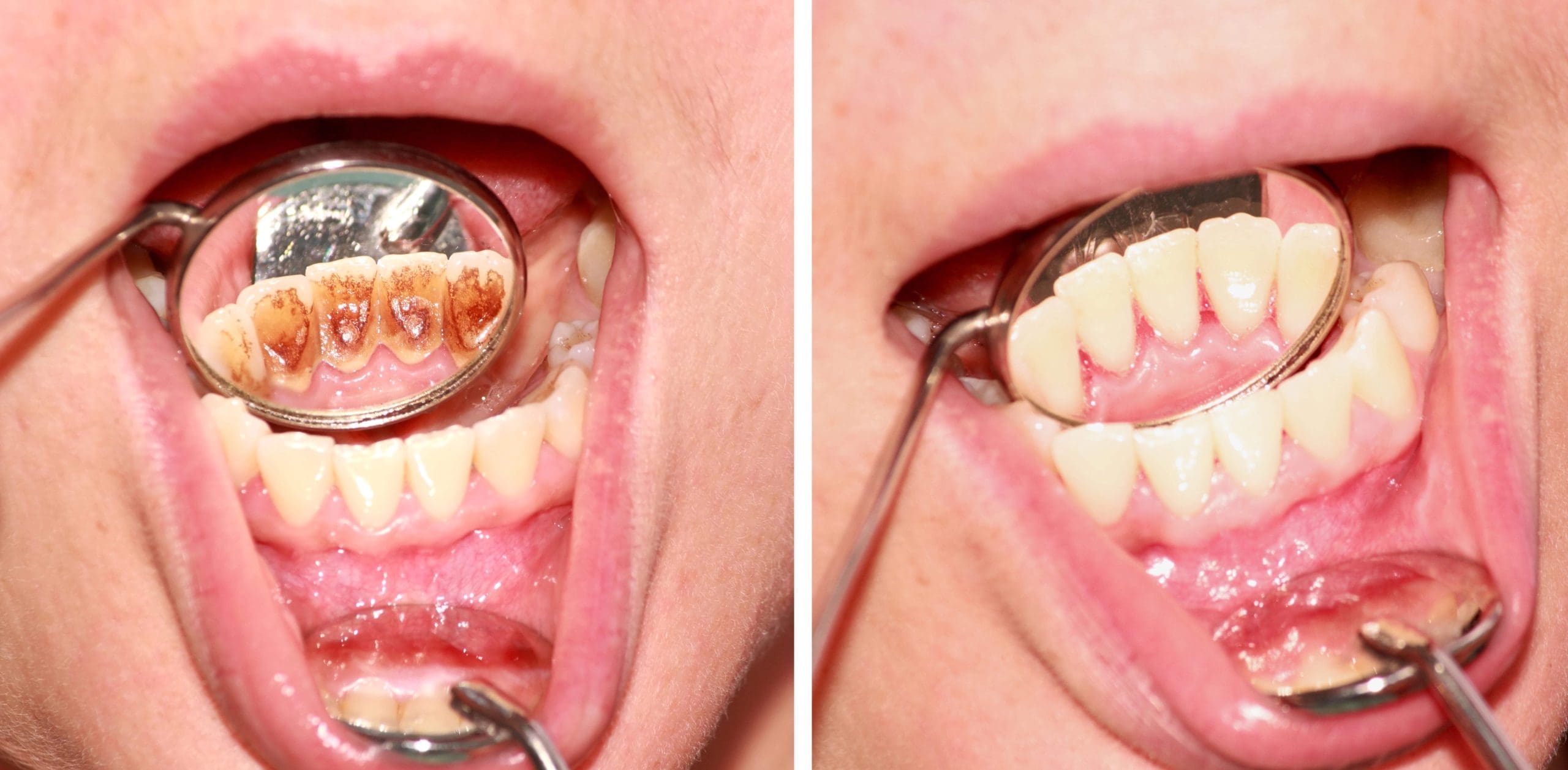 Tartar Before and After Dental Cleaning